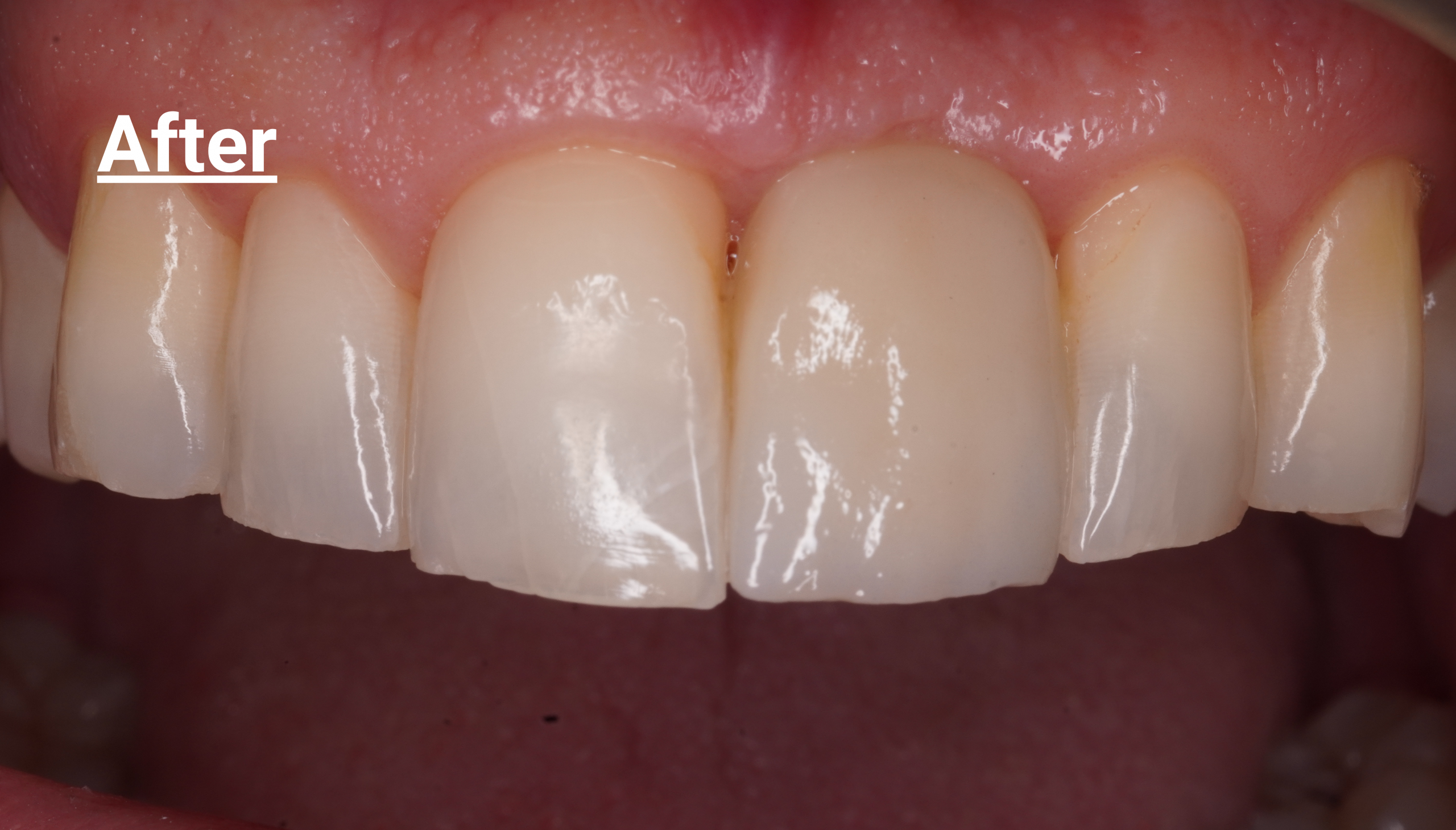 After - Implant case large