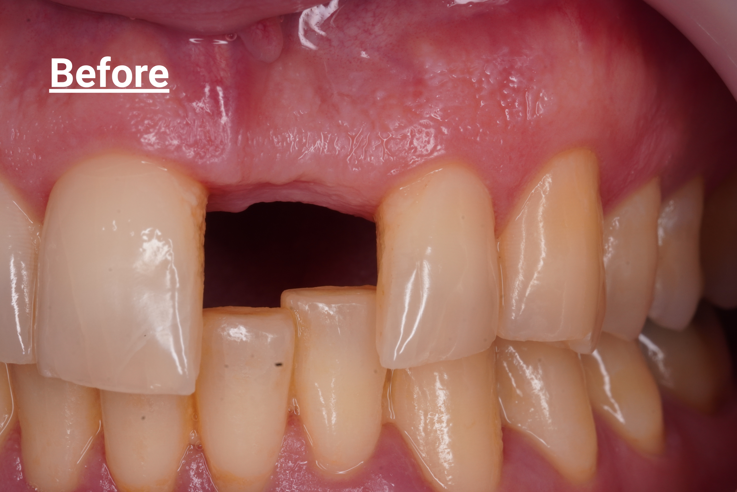 Before - Implant case large