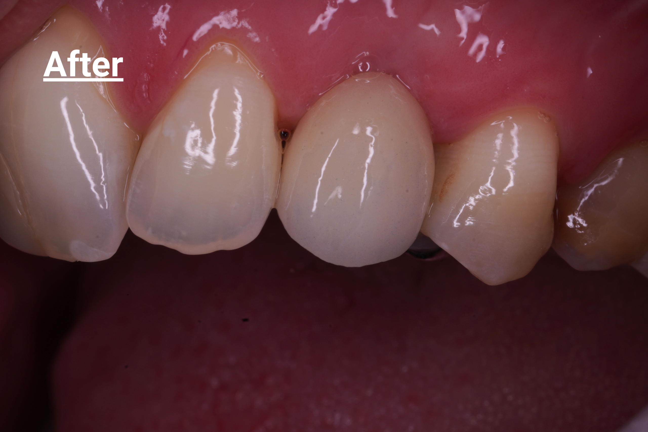 Implant case molar - After