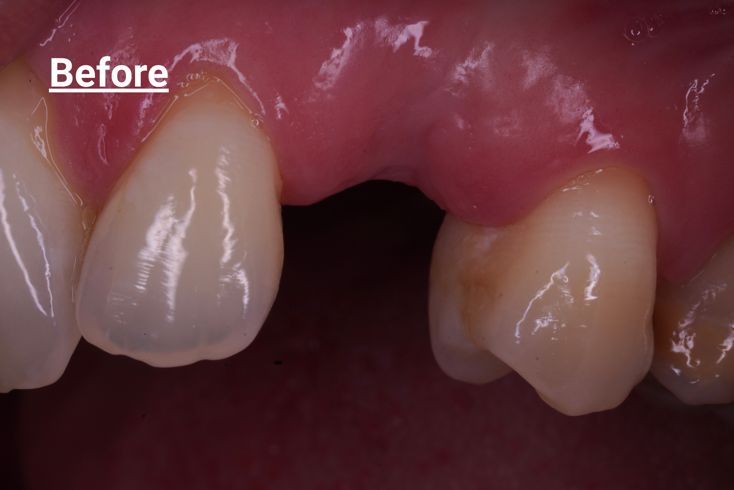 Implant case molar - Before